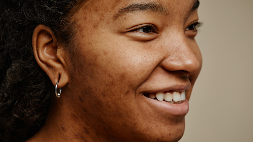 Personalized acne treatment