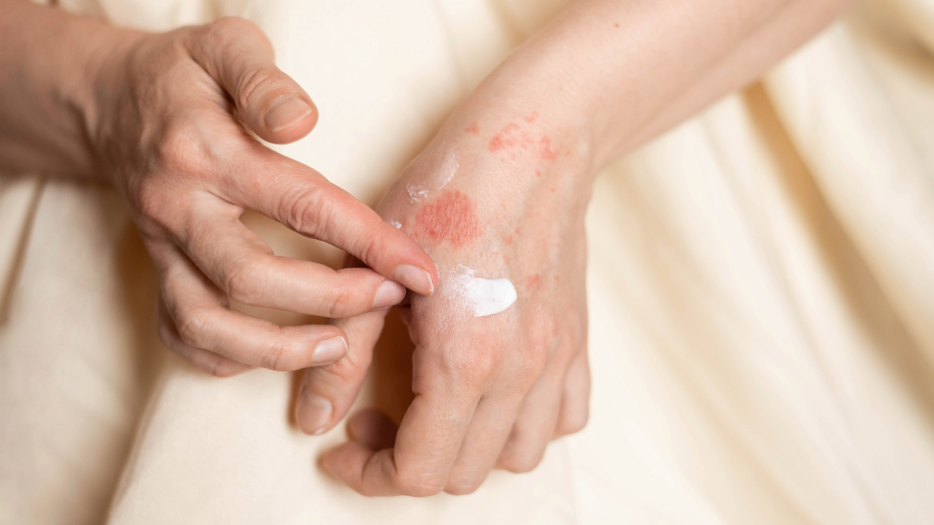 psoriasis treatment Nashville